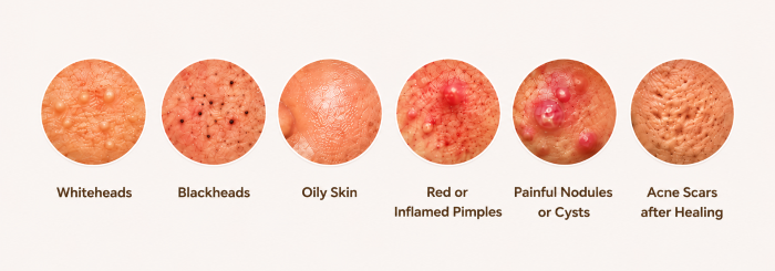 Symptoms of Acne in Thane at Ameya Skin Clinic