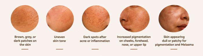 Symptoms of Pigmentation & Melasma in Thane at Ameya Skin Clinic